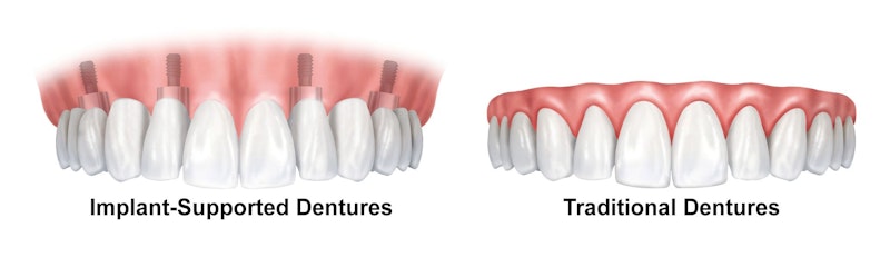 Comparison of implant-supported dentures and traditional dentures showing dental restoration options.