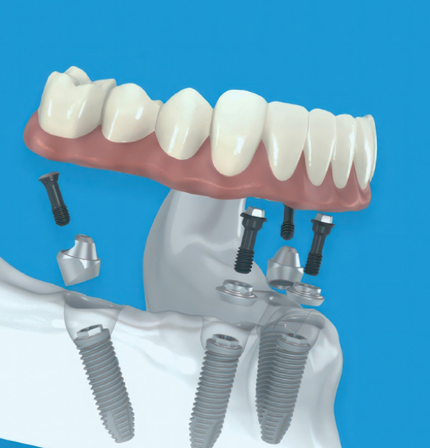 3D dental implant illustration showing prosthetic teeth, implant screws, and abutments on blue background.