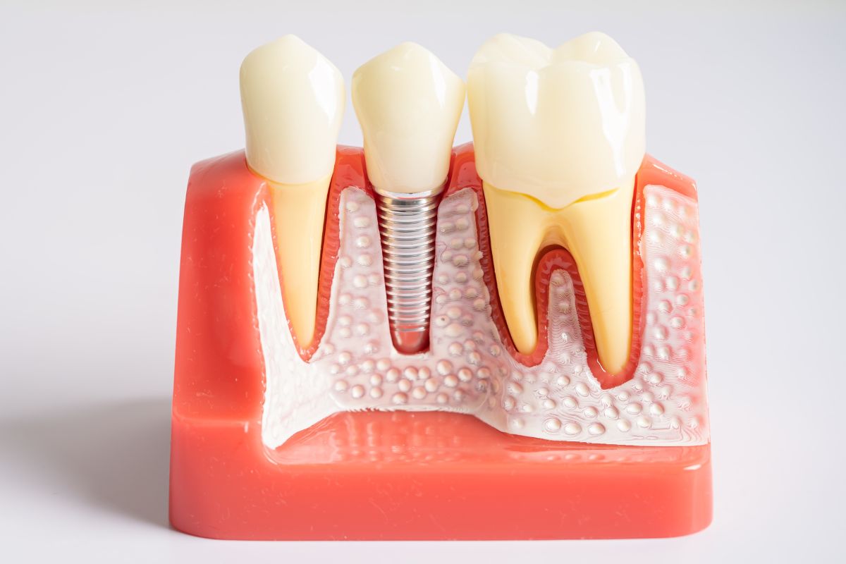 dental implants
