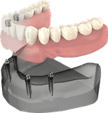 Dental implant model showing prosthetic teeth attached to jawbone structure with surgical guide.