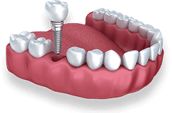 Dental implant model showing tooth replacement procedure on artificial gum structure.