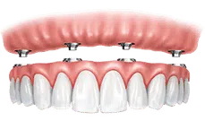 Dental implant illustration showing gum tissue above row of white artificial teeth prosthetic.