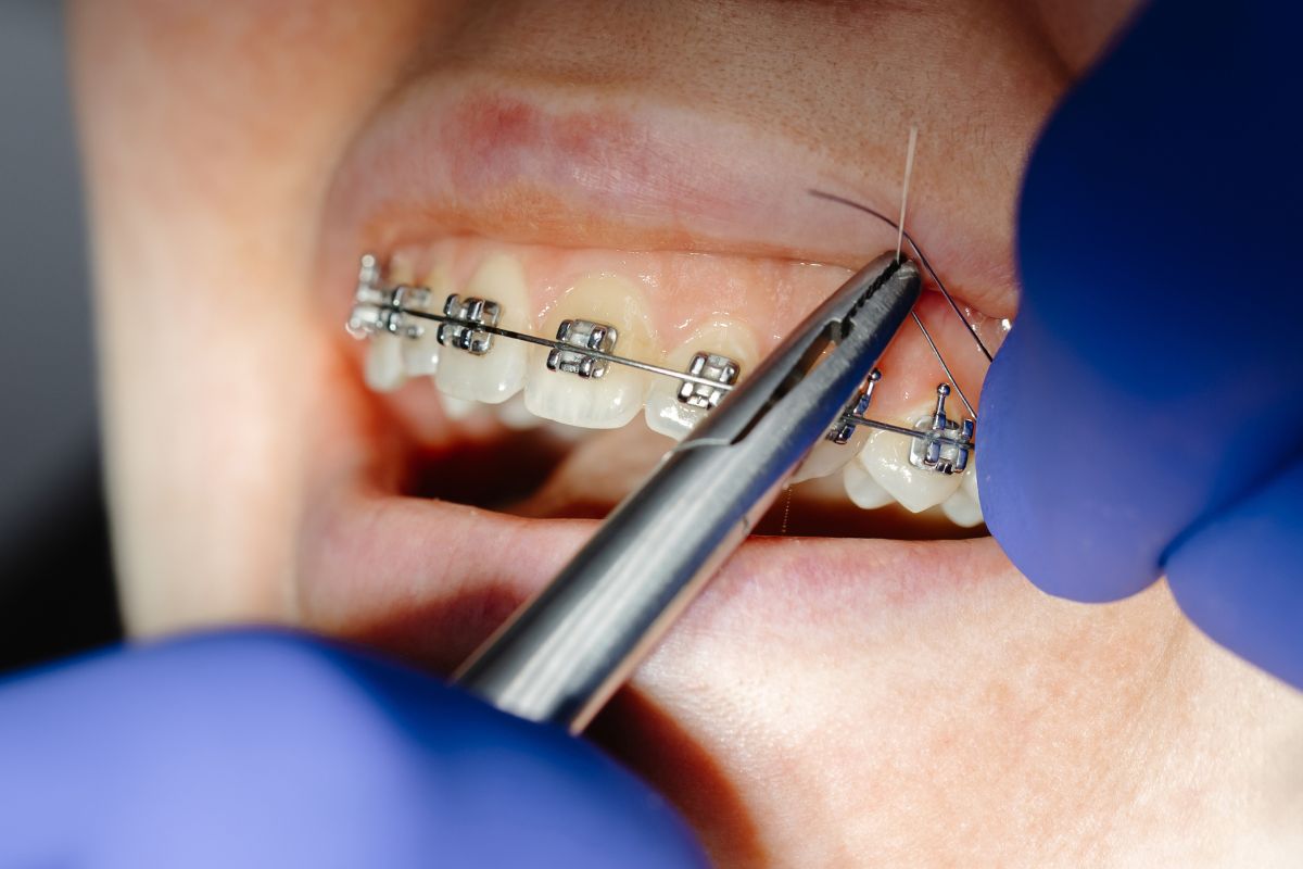 Early Braces Removal