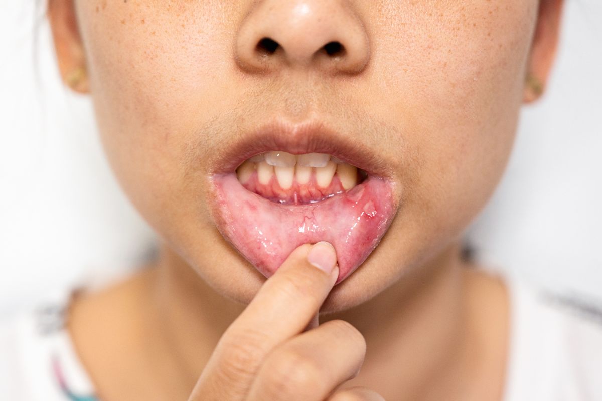 Mouth Ulcers