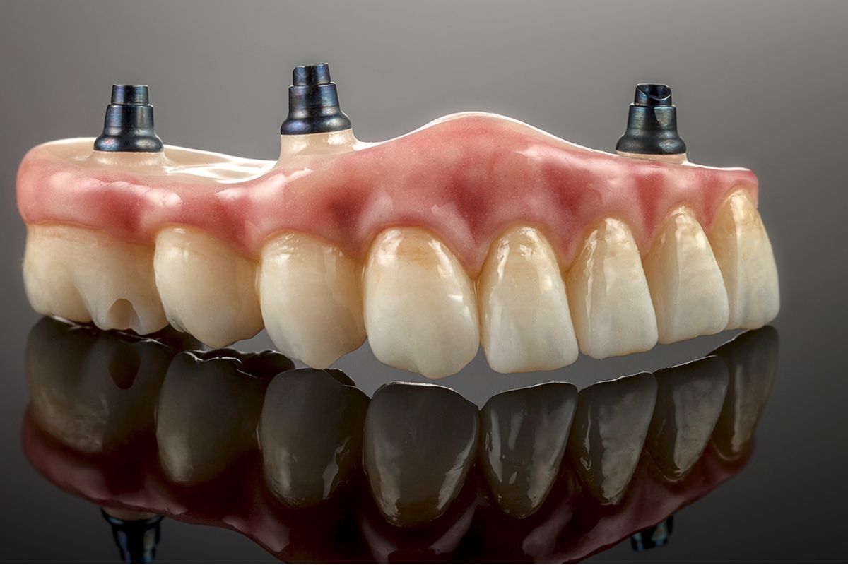 Full Arch Dental Implants