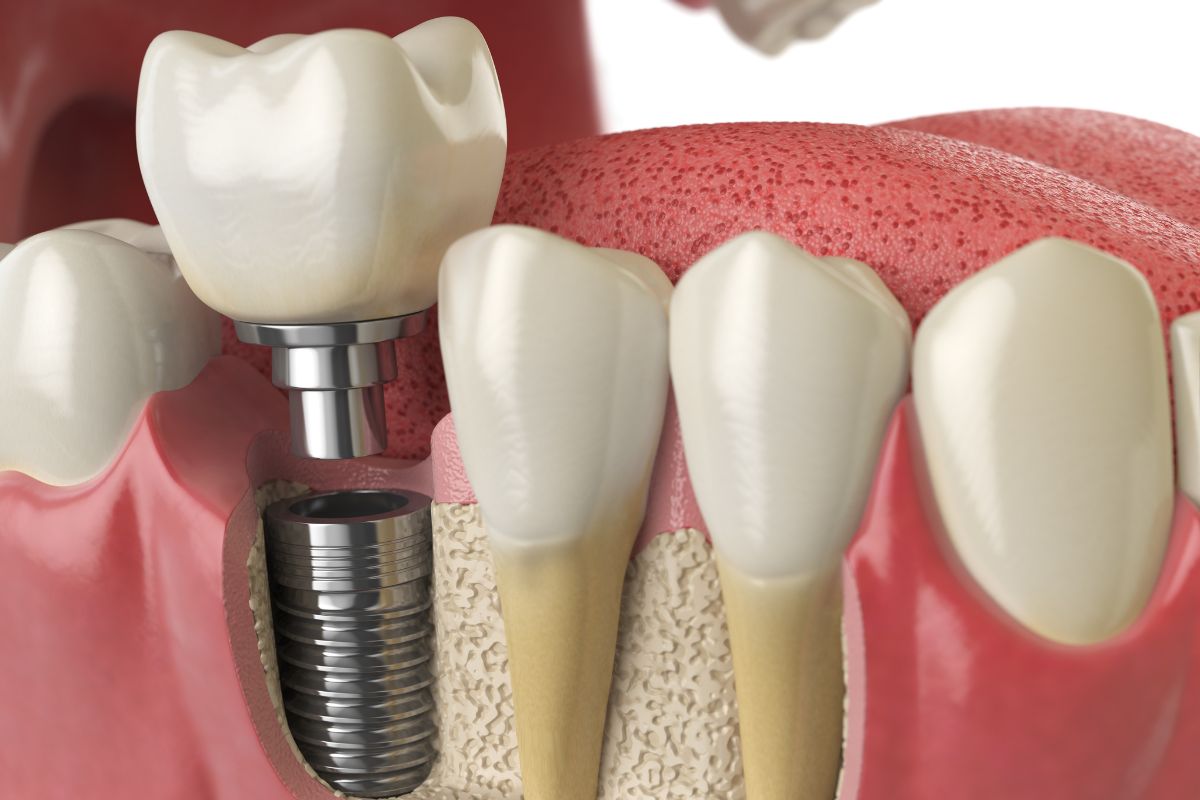 Dental Implants Become Infected