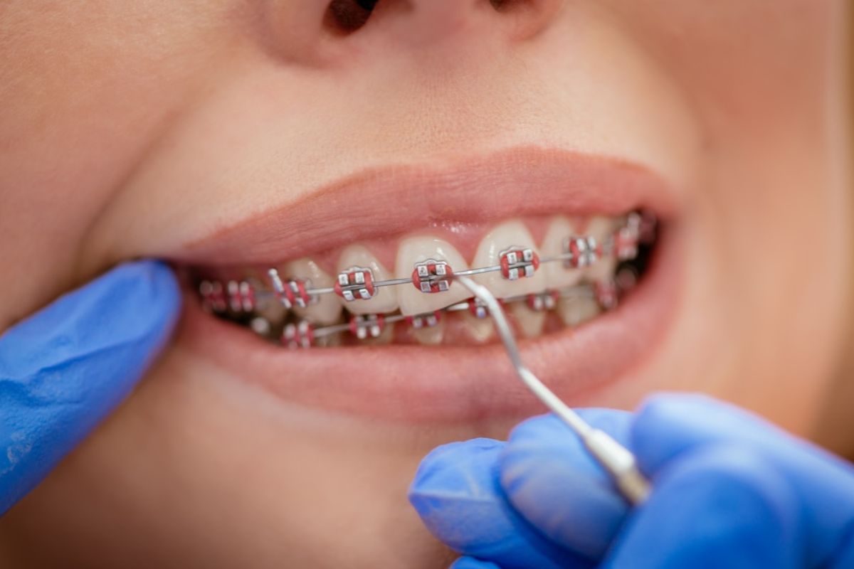 dental braces