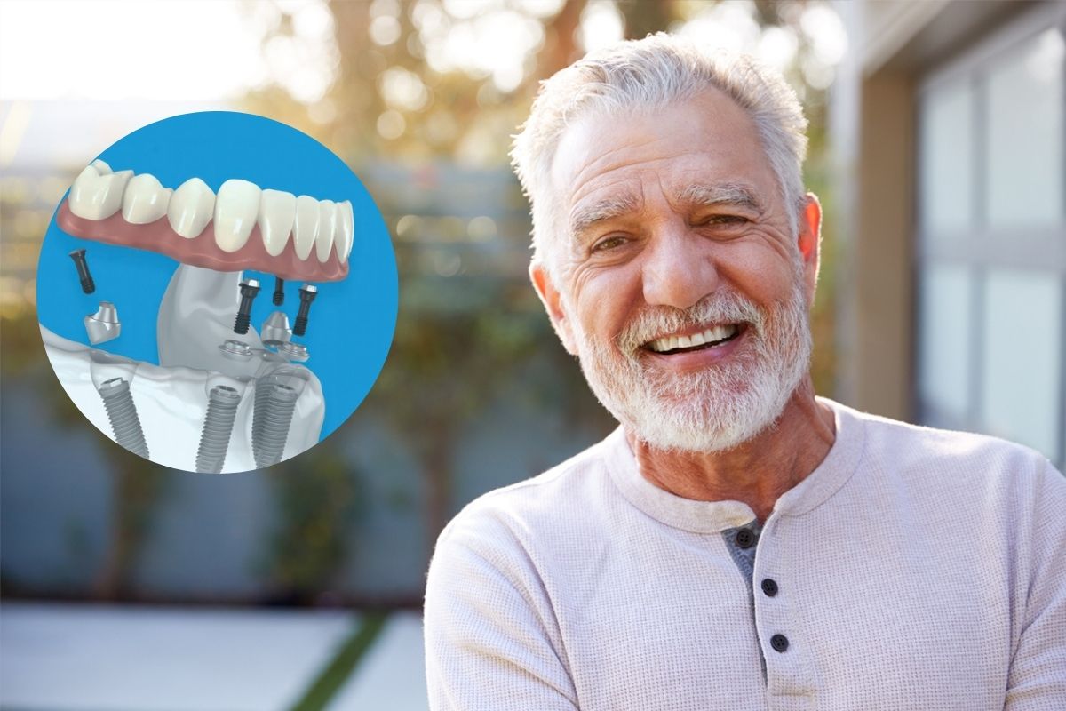 Recovery Timeline After All-on-4 Dental Implants